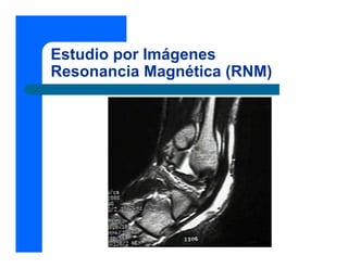 Estudio por Imágenes
Resonancia Magnética (RNM)
 