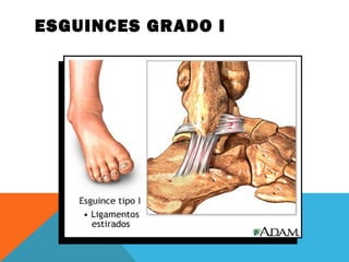 ESGUINCES GRADO I 
 