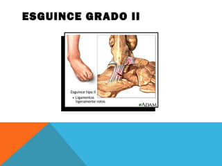 ESGUINCE GRADO II 
 