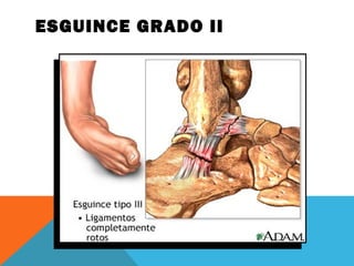 ESGUINCE GRADO II 
 