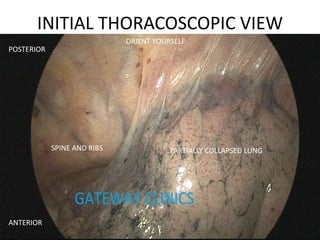 INITIAL THORACOSCOPIC VIEW
SPINE AND RIBS PARTIALLY COLLAPSED LUNG
ORIENT YOURSELF
POSTERIOR
ANTERIOR
 