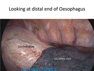 Looking at distal end of Oesophagus
DIAPHRAGM
COLLAPSED LUNG
 