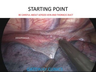 STARTING POINT
OESOPHAGUS
BE CAREFUL ABOUT AZYGOS VEIN AND THORACIC DUCT
 
