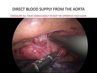 DIRECT BLOOD SUPPLY FROM THE AORTA
COAGULATE ALL THESE VESSELS NICELY TO KEEP THE OPERATIVE FIELD CLEAN
 