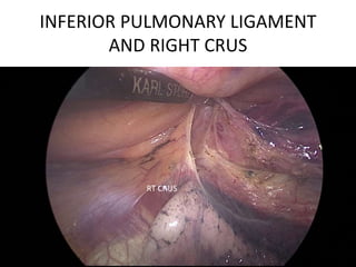 INFERIOR PULMONARY LIGAMENT
AND RIGHT CRUS
RT CRUS
 