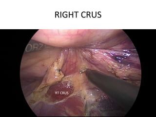 RIGHT CRUS
RT CRUS
 