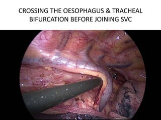 CROSSING THE OESOPHAGUS & TRACHEAL
BIFURCATION BEFORE JOINING SVC
 
