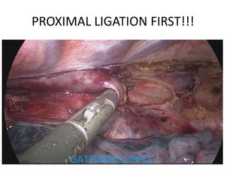 PROXIMAL LIGATION FIRST!!!
 