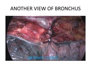 ANOTHER VIEW OF BRONCHUS
 