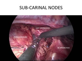 SUB-CARINAL NODES
PERICARDIUM
RT BRONCHUS
LEFT BRONCHUS
 