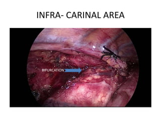INFRA- CARINAL AREA
BIFURCATION
 
