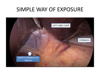 SIMPLE WAY OF EXPOSURE
LEFT LOBE LIVER
STOMACH
HEPATIC BRANCH OF
VAGUS
 