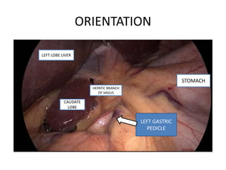 ORIENTATION
CAUDATE
LOBE
LEFT GASTRIC
PEDICLE
STOMACH
LEFT LOBE LIVER
HEPATIC BRANCH
OF VAGUS
 