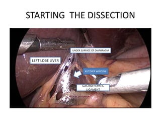STARTING THE DISSECTION
GASTRO HEPATIC
LIGAMENT
KUTZNER WINDOW
LEFT LOBE LIVER
UNDER SURFACE OF DIAPHRAGM
 