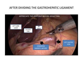 AFTER DIVIDING THE GASTROHEPATIC LIGAMENT
LEFT LOBE
LIVER
CAUDATE
LOBE
COMMON
HAPATIC ARTERY
LEFT GASTRIC
VEIN
RT
CRUS
APPRECIATE THE ANATOMY BEFORE DISSECTING
 