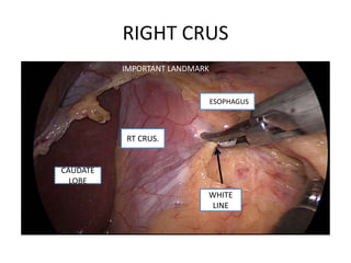 RIGHT CRUS
RT CRUS.
WHITE
LINE
CAUDATE
LOBE
ESOPHAGUS
IMPORTANT LANDMARK
 