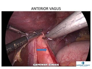 ANTERIOR VAGUS
 