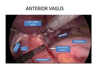 ANTERIOR
VAGUS
STOMACH
ESOPHAGUS
RT
CRUS
LEFT LOBE
LIVER
ANTERIOR VAGUS
 