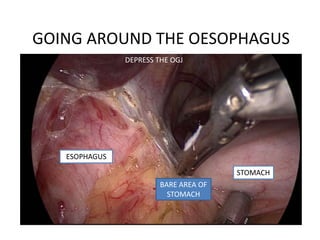 GOING AROUND THE OESOPHAGUS
BARE AREA OF
STOMACH
STOMACH
ESOPHAGUS
DEPRESS THE OGJ
 