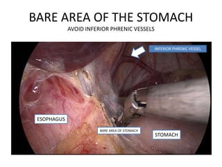 BARE AREA OF THE STOMACH
AVOID INFERIOR PHRENIC VESSELS
INFERIOR PHRENIC VESSEL
STOMACH
ESOPHAGUS
BARE AREA OF STOMACH
 