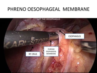PHRENO OESOPHAGEAL MEMBRANE
PHRENO
ESOPHAGEAL
MEMBRANE
ESOPHAGUS
RT CRUS
LIFT THE OESOPHAGUS
 