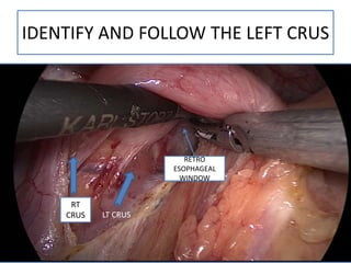 IDENTIFY AND FOLLOW THE LEFT CRUS
RETRO
ESOPHAGEAL
WINDOW
RT
CRUS LT CRUS
 