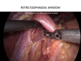 RETRO ESOPHAGEAL WINDOW
IMPORTANCE OF THE SURGICAL PLANES
 