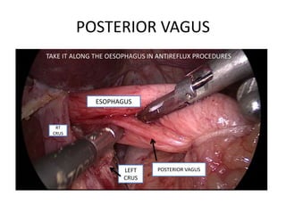 POSTERIOR VAGUS
POSTERIOR VAGUS
ESOPHAGUS
RT
CRUS
LEFT
CRUS
TAKE IT ALONG THE OESOPHAGUS IN ANTIREFLUX PROCEDURES
 