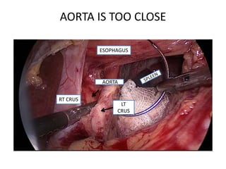 AORTA IS TOO CLOSE
AORTA
RT CRUS
LT
CRUS
ESOPHAGUS
 