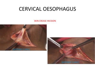 CERVICAL OESOPHAGUS
SKIN CREASE INCISION
 