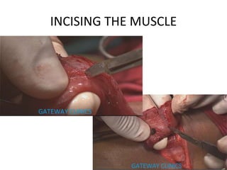 INCISING THE MUSCLE
 
