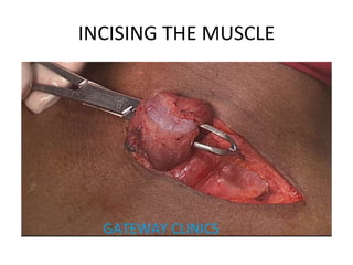 INCISING THE MUSCLE
 
