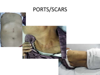 PORTS/SCARS
 