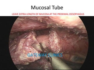 Mucosal Tube
LEAVE EXTRA LENGTH OF MUCOSA AT THE PROXIMAL OESOPHAGUS
 