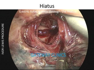Hiatus
Gastric tube is seen through the hiatus
IVORLEWISPROCEDURE
 
