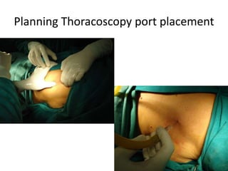 Planning Thoracoscopy port placement
 