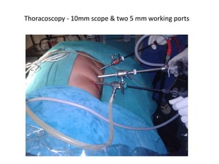 Thoracoscopy - 10mm scope & two 5 mm working ports
 