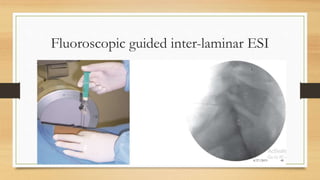 Epidural Steroid Injection in low back pain | PPTX