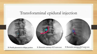 Intraforaminal Injection Epidural Steroid Injection in low back pain | PPTX
