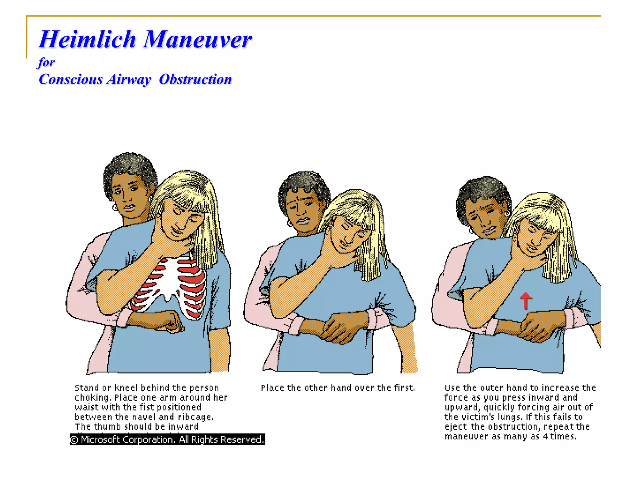 Heimlich Maneuver
for
Conscious Airway Obstruction
 