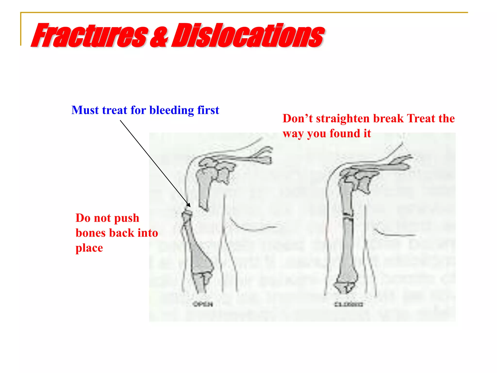 Fractures & Dislocations
Must treat for bleeding first
Do not push
bones back into
place
Don’t straighten break Treat the
way you found it
 