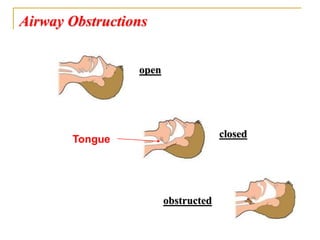 Airway Obstructions
open
closed
obstructed
Tongue
 