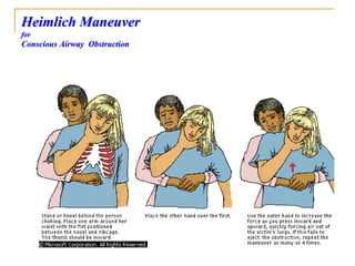 Heimlich Maneuver
for
Conscious Airway Obstruction
 