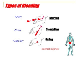 Types of Bleeding
•Veins
•Capillary
Spurting
Steady flow
Oozing
Artery
Internal Injuries
 