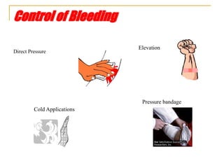 Control of Bleeding
Direct Pressure
Elevation
Cold Applications
Pressure bandage
 