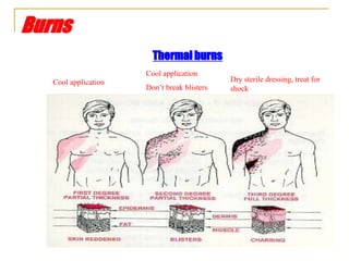 Burns
Thermal burns
Cool application
Cool application
Don’t break blisters
Dry sterile dressing, treat for
shock
 