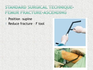 Position –supine
 Reduce fracture – F tool
 