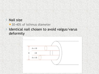  Nail size
 30-40% of isthmus diameter
 Identical nail chosen to avoid valgus/varus
deformity
 