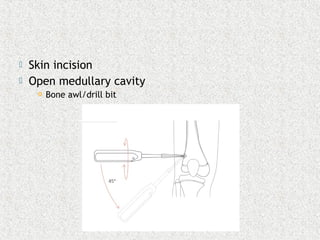  Skin incision
 Open medullary cavity
 Bone awl/drill bit
 