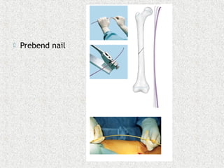  Prebend nail
 
